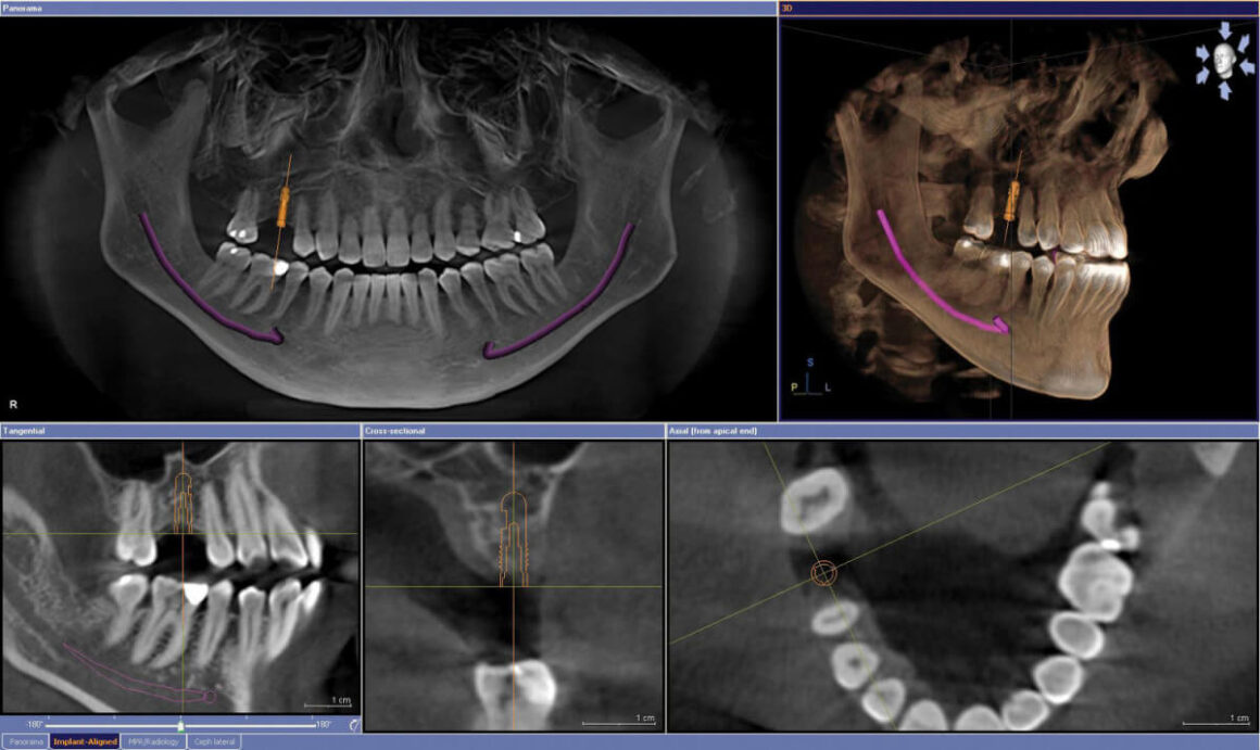 КОМПЬЮТЕР ТОМОГРАФ БУЮУ CBCT